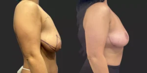 Bilateral Mastopexy  #001, before and after photo, view 2
