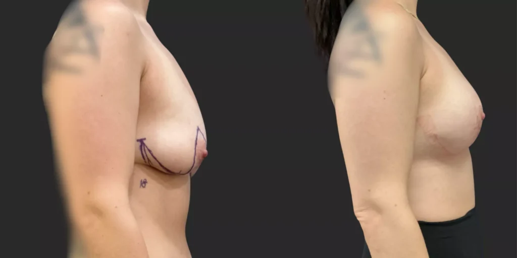 Bilateral Mastopexy  #003, before and after photo, view 2