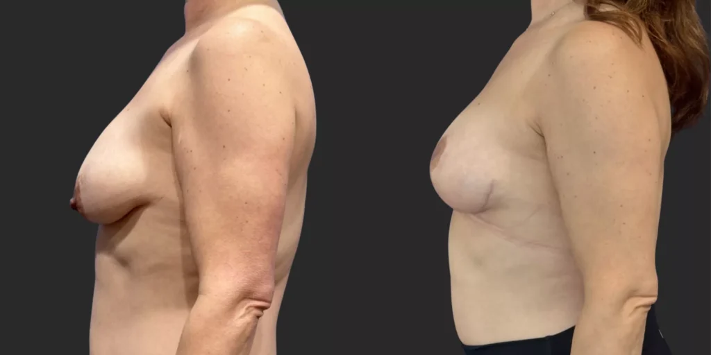 Bilateral Mastopexy  #002, before and after photo, view 2