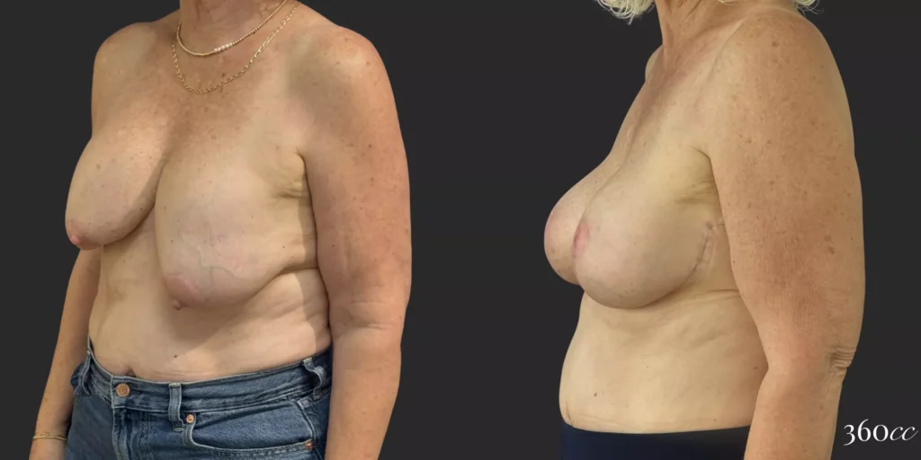 Bilateral Implant Exchange and Bilateral Mastopexy  #005, before and after photo, view 2