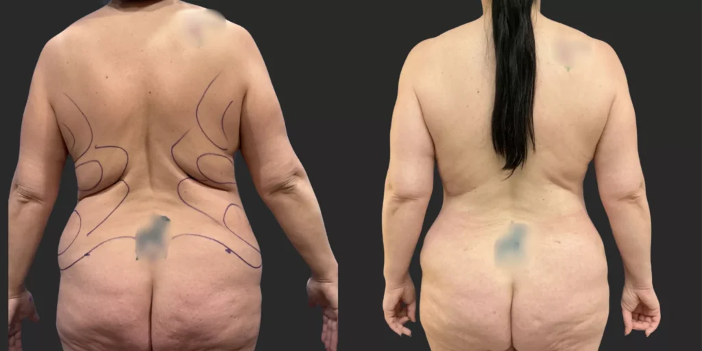 Bilateral Mastopexy, Abdominoplasty and Liposuction of Hips, Waist and Back Bra Roll  #007, before and after photo, view 2