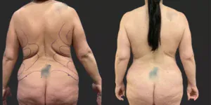 Bilateral Mastopexy, Abdominoplasty and Liposuction of Hips, Waist and Back Bra Roll  #007, before and after photo, view 2