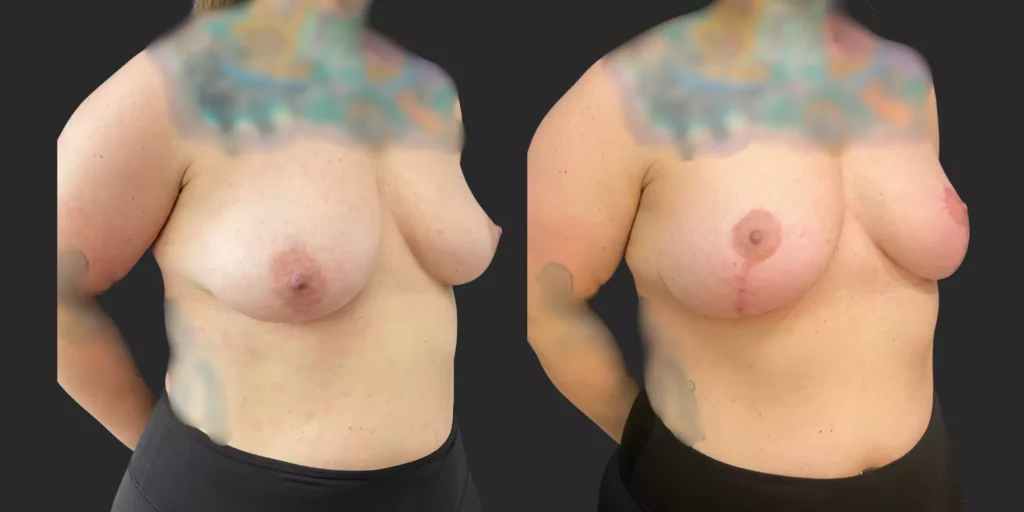 Bilateral Mastopexy with R Breast Reduction  #014, before and after photo, view 2