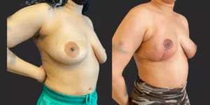 Bilateral Mastopexy  #018, before and after photo, view 2