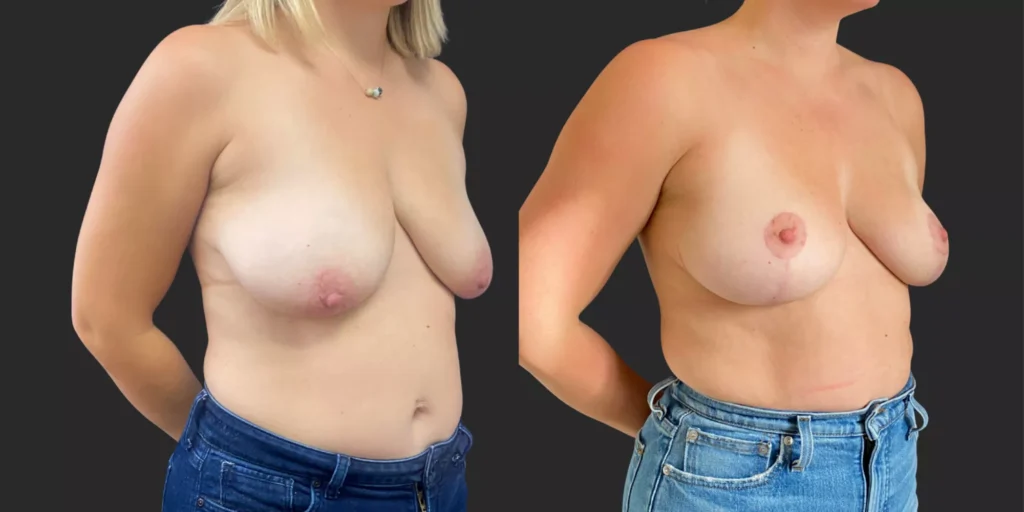 Bilateral Mastopexy  #013, before and after photo, view 2