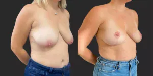 Bilateral Mastopexy  #013, before and after photo, view 2