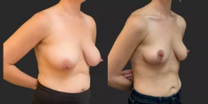Bilateral Mastopexy  #012, before and after photo, view 2