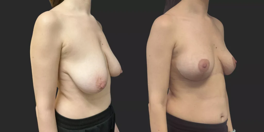 Bilateral Mastopexy  #008, before and after photo, view 2