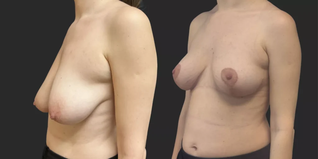 Bilateral Mastopexy  #006, before and after photo, view 2
