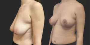 Bilateral Mastopexy  #006, before and after photo, view 2