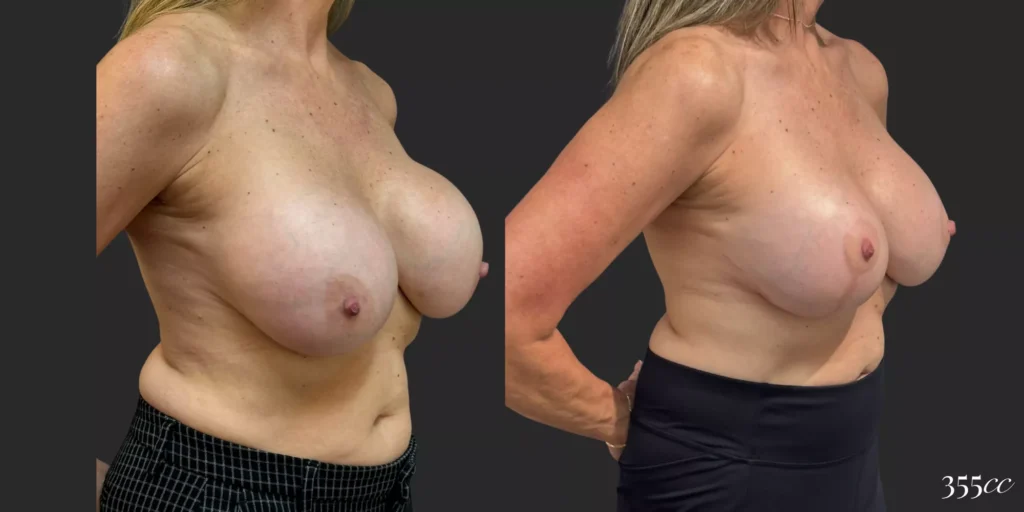 Bilateral Mastopexy and Bilateral Implant Exchange  #011, before and after photo, view 2