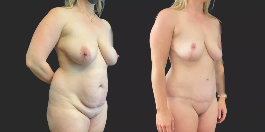 Abdominoplasty with Lipo of Hips/Waist and Bilateral Mastopexy  #017, before and after photo, view 2