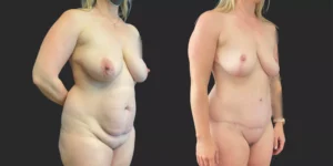 Abdominoplasty with Lipo of Hips/Waist and Bilateral Mastopexy  #017, before and after photo, view 2