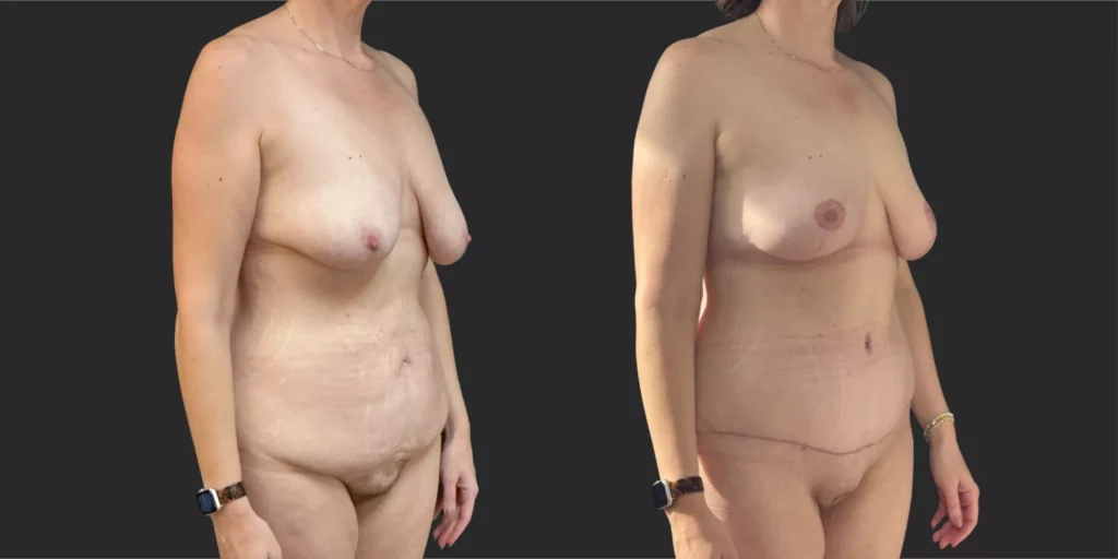 Abdominoplasty with Bilateral Mastopexy  #009, before and after photo, view 2