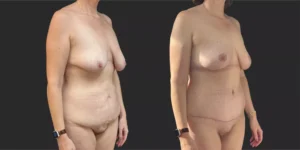 Abdominoplasty with Bilateral Mastopexy  #009, before and after photo, view 2