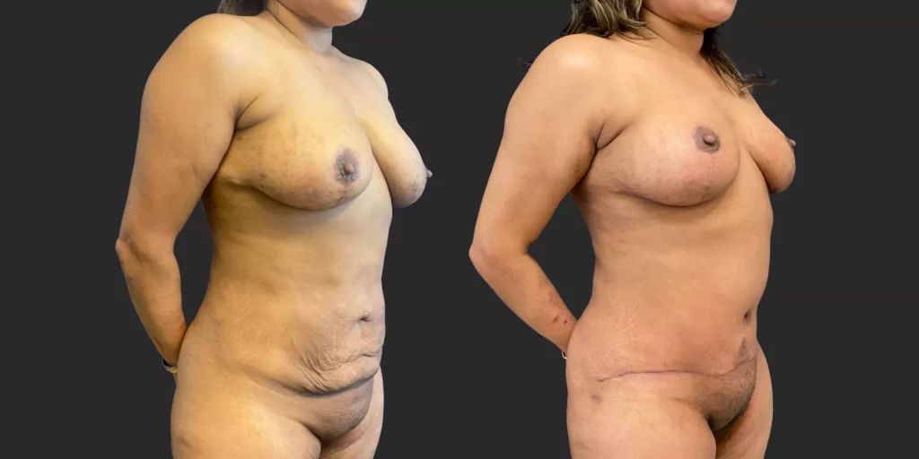 Abdominoplasty + Bilateral Mastopexy  #019, before and after photo, view 2