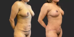 Abdominoplasty + Bilateral Mastopexy  #019, before and after photo, view 2