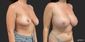 Modified Bilateral Mastopexy + Bilateral Implant Exchange  #010, before and after photo, view 2
