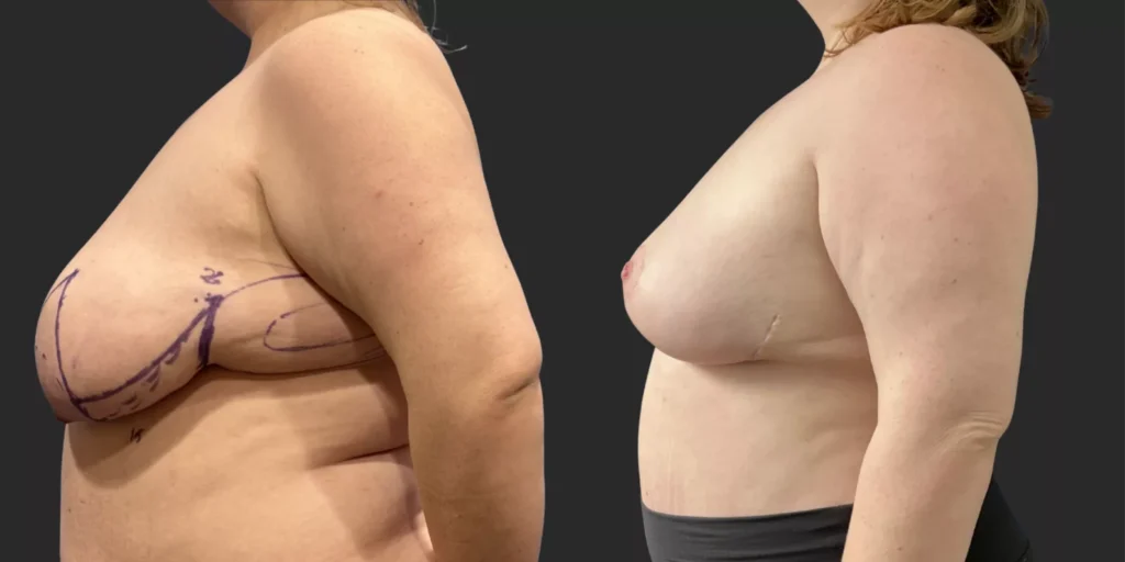 Bilateral Reduction and Lipo of Lateral Breasts #008, before and after photo, view 2