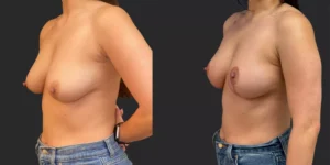 Mastopexy  #023, before and after photo, view 2