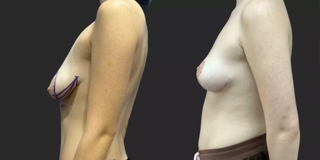 Mastopexy  #022, before and after photo, view 2