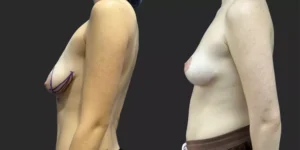 Mastopexy  #022, before and after photo, view 2