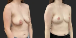 Mastopexy  #021, before and after photo, view 2