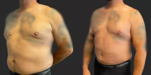 360 Lipo and Gynecomastia Reduction #005, before and after photo, view 2