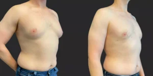Gynecomastia Reduction #006, before and after photo, view 2