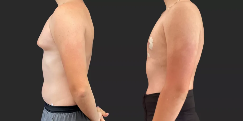 Gynecomastia Reduction #002, before and after photo, view 2