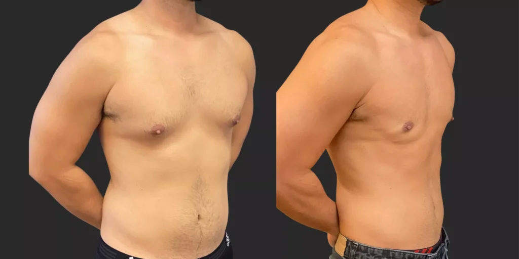 Gynecomastia Reduction with Lipo #003, before and after photo, view 2