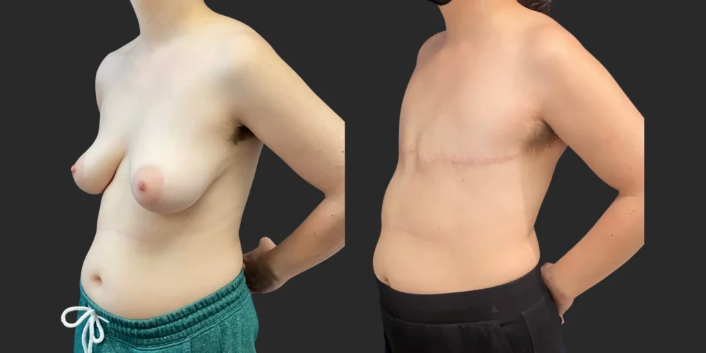 Gender Affirming Surgery #013, before and after photo, view 2