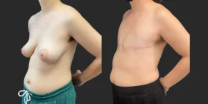 Gender Affirming Surgery #013, before and after photo, view 2