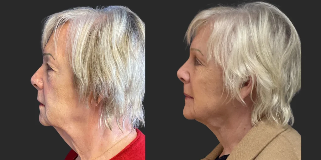 Cameo III Facelift & Bilateral Upper / Lower Blepharoplasty #013, before and after photo, view 2