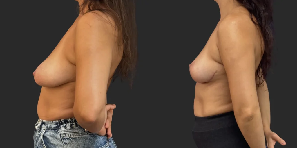 Mastopexy  #027, before and after photo, view 3