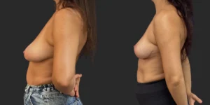 Mastopexy  #027, before and after photo, view 3