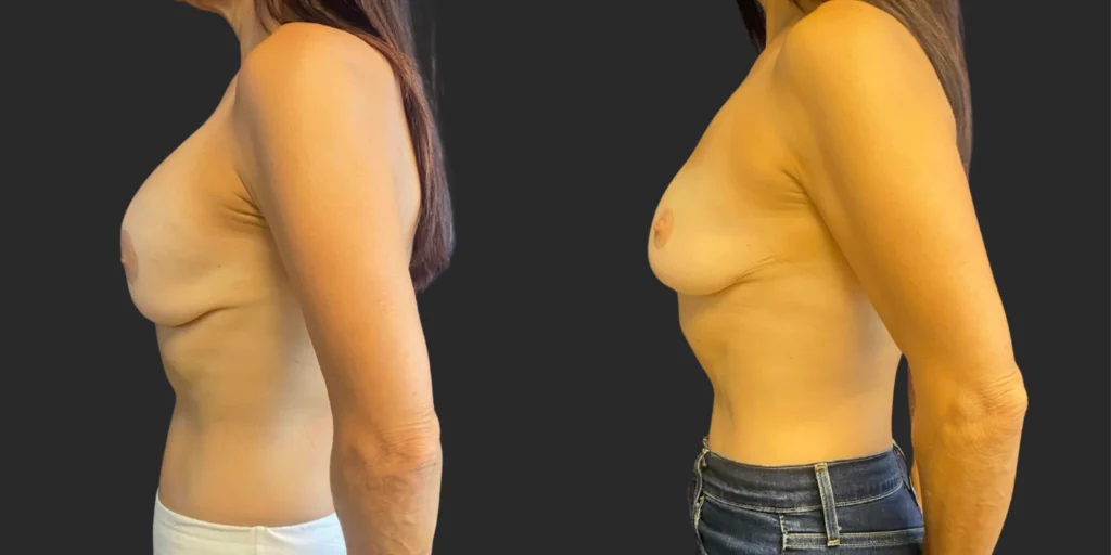Bilateral Implant Removal #014, before and after photo, view 3