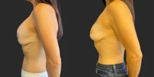 Bilateral Implant Removal #014, before and after photo, view 3