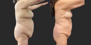 Lipo of Upper/Lower Abdomen, Pubis, Front Bra Roll, Lateral Breasts #035, before and after photo, view 3