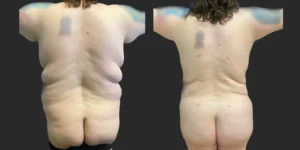 Lipo to Hips/Waist/Back Bra Roll with Fat Transfer to Buttocks #037, before and after photo, view 3