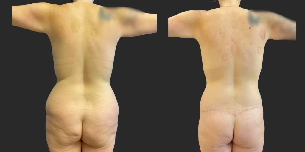 Abdominoplasty and Belt Lipectomy #003, before and after photo, view 3