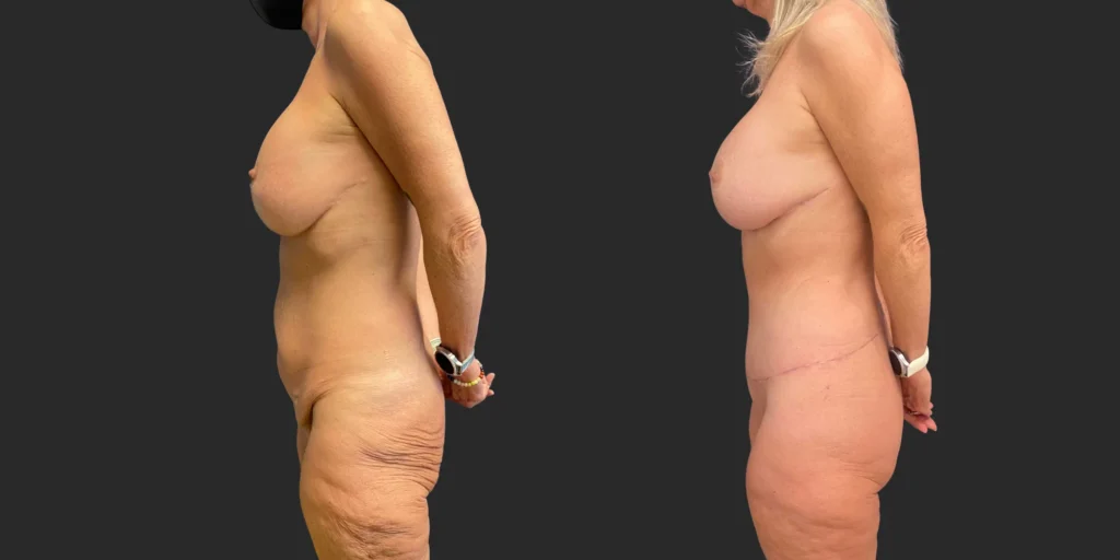 Abdominoplasty #009, before and after photo, view 3