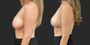 Bilateral Breast Reduction  #010, before and after photo, view 3