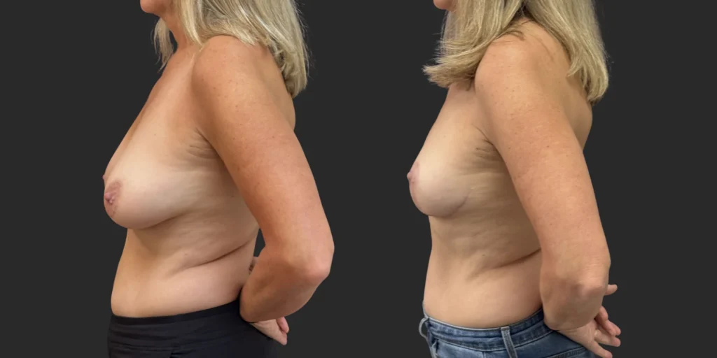 Bilateral Breast Reduction  #011, before and after photo, view 3