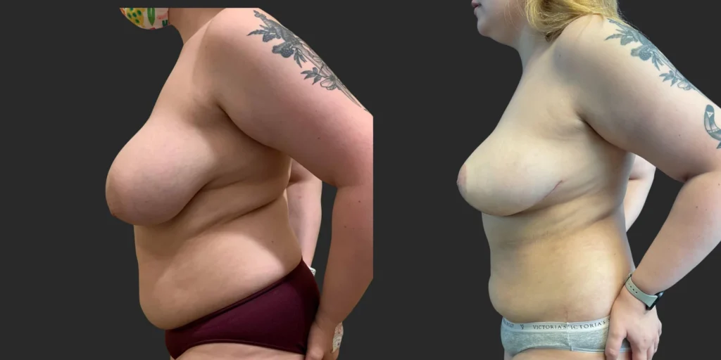 Breast Reduction  #012, before and after photo, view 3