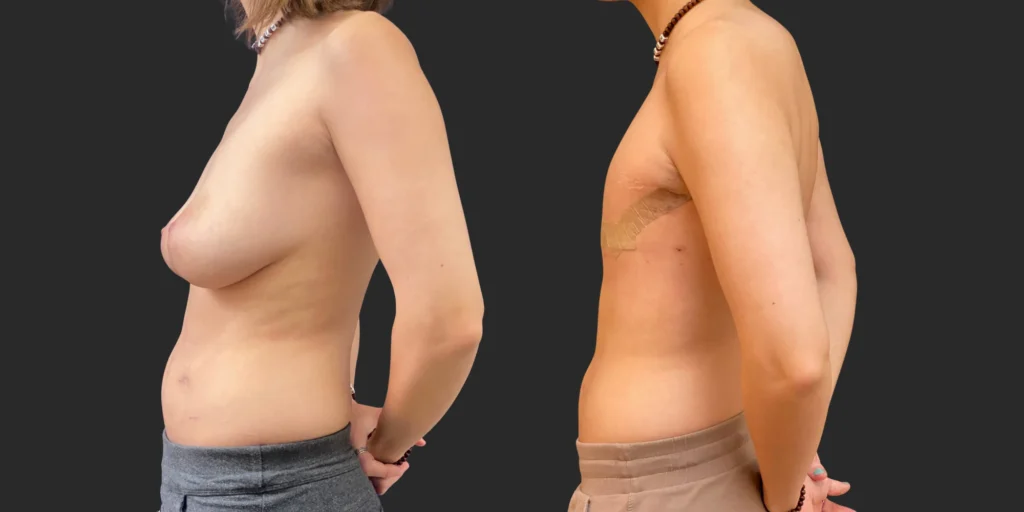 Gender Affirming Surgery #011, before and after photo, view 3