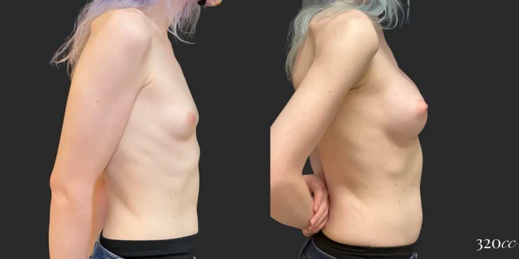 Breast Augmentation and Gender Affirming Surgery #012, before and after photo, view 3