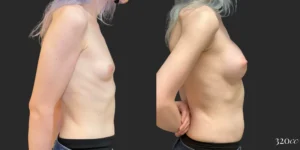 Breast Augmentation and Gender Affirming Surgery #012, before and after photo, view 3