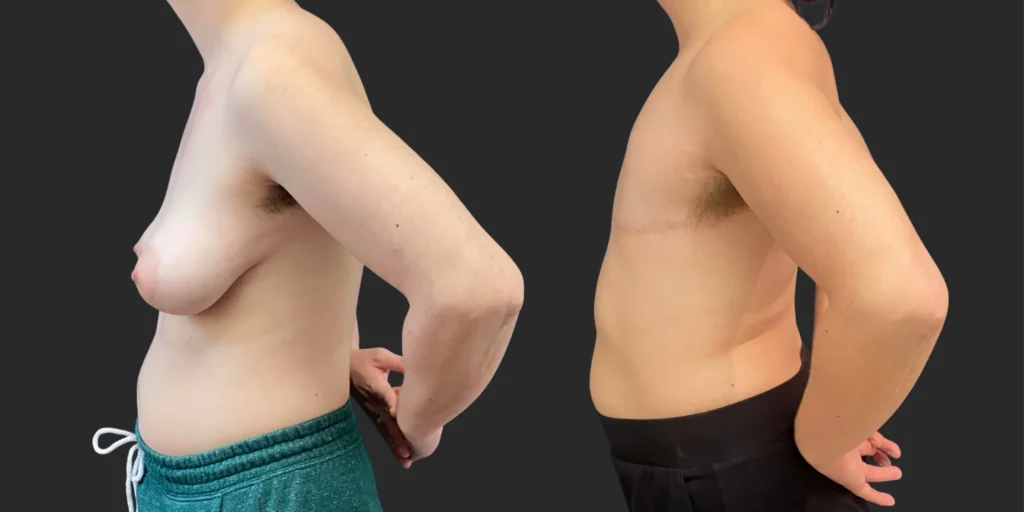 Gender Affirming Surgery #013, before and after photo, view 3