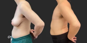 Gender Affirming Surgery #013, before and after photo, view 3